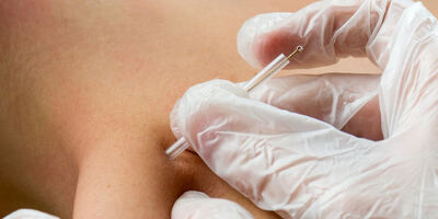 IMS, dry needling, functional dry needling, intramuscular stimulation, acupuncture